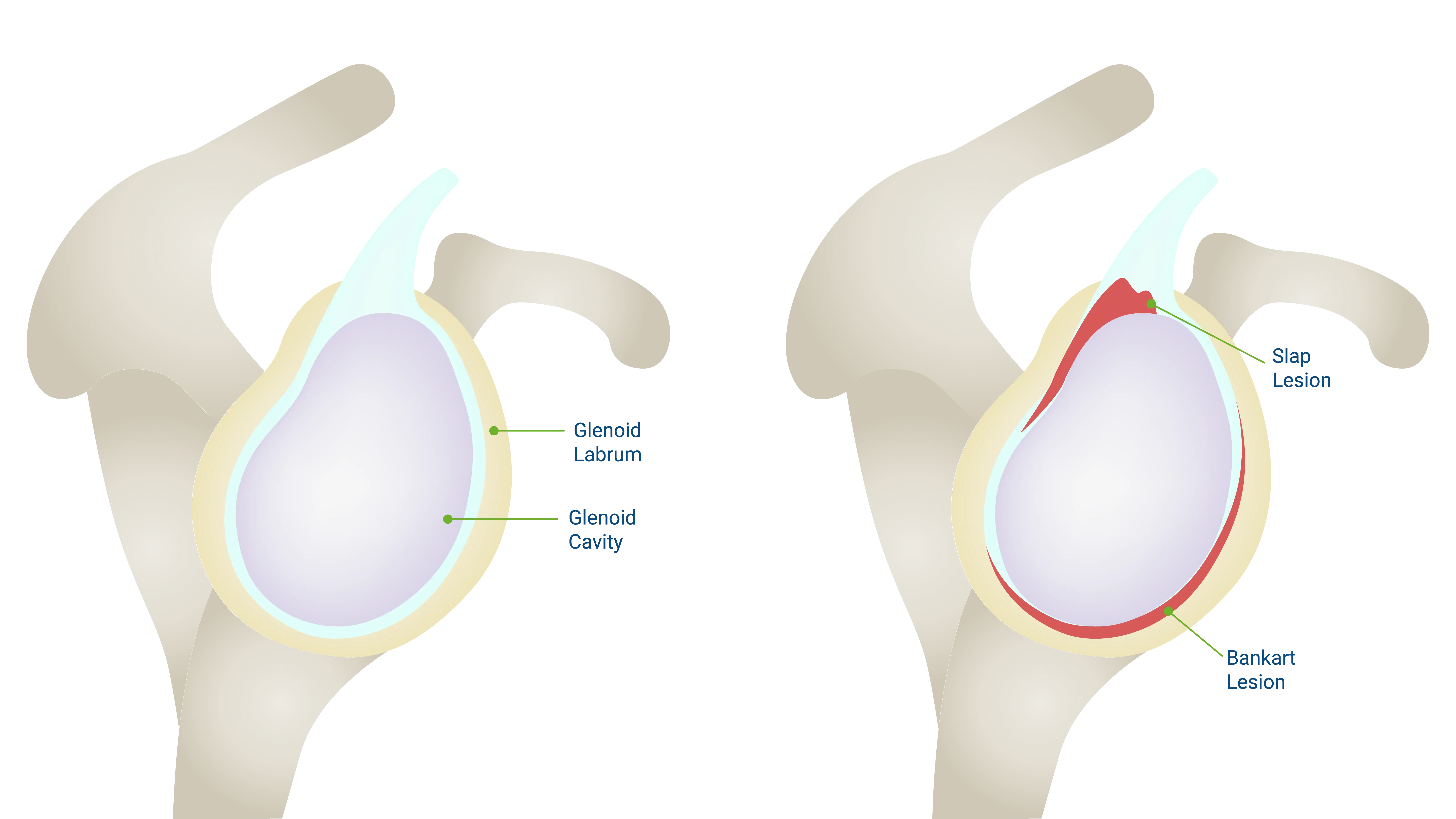 Anatomical Graphic Labral Tear