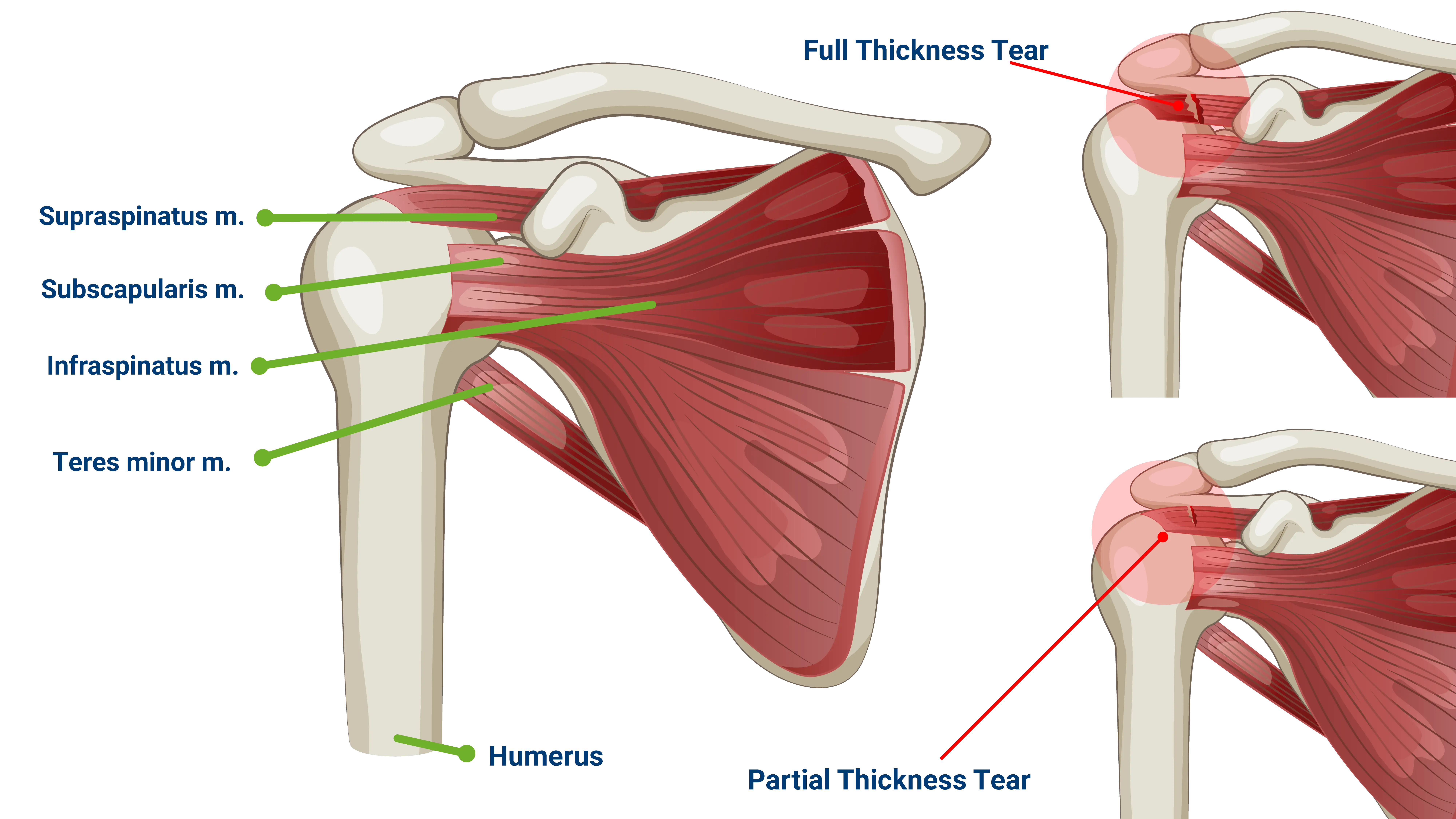 Anatomical Graphic Rotator Cuff Tear Types