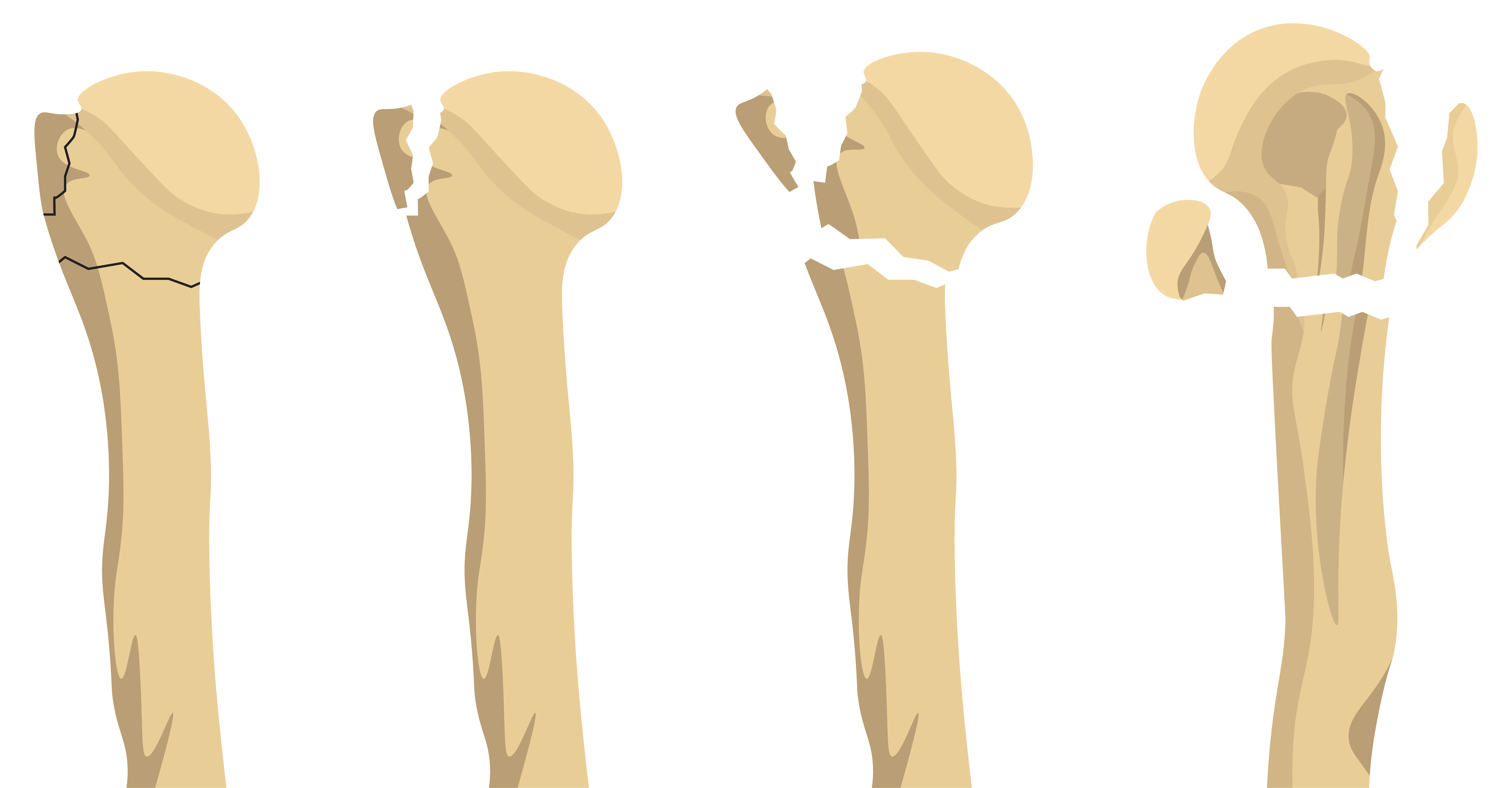 Neer Classification System