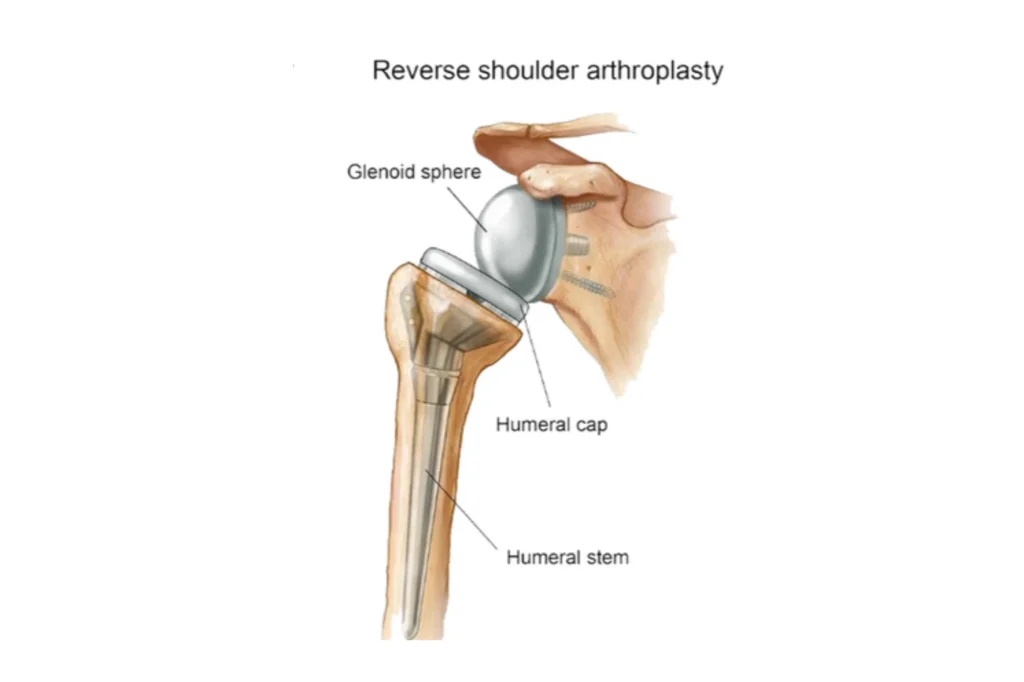 Reverse shoulder replacement