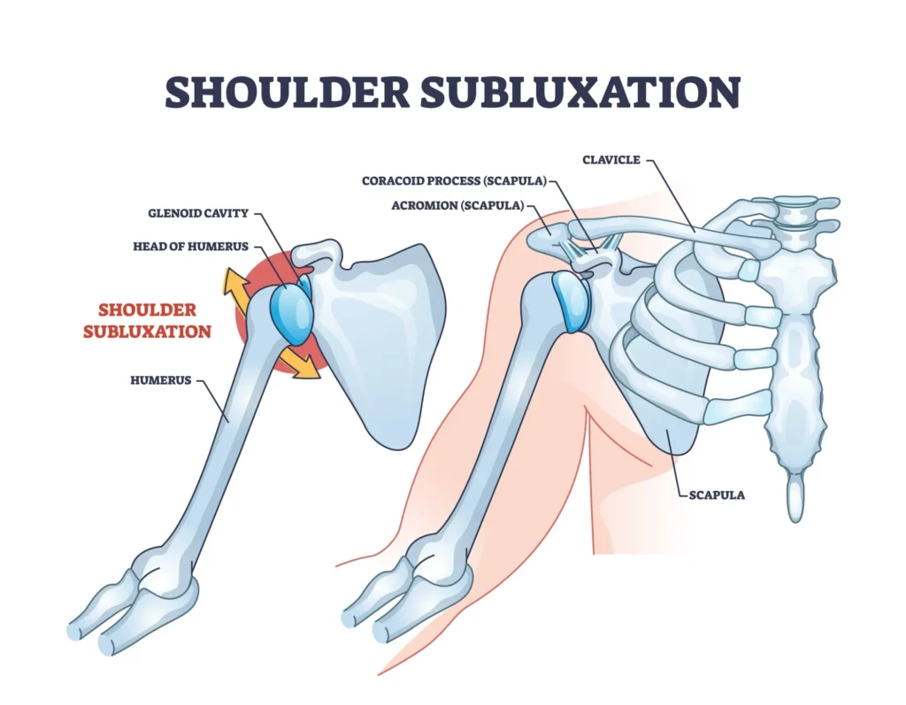 Diagram of shoulder subluxation