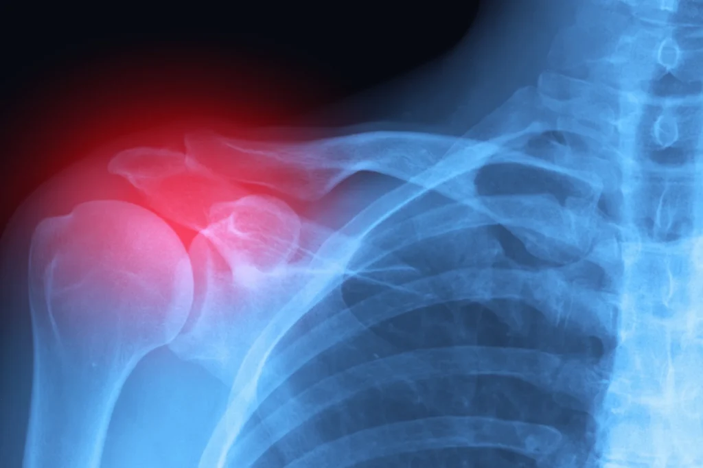 Shoulder fracture anatomy, XRay