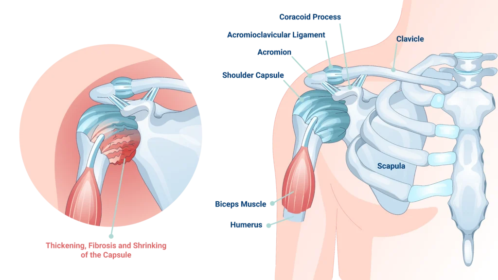 anatomical labeled image of a frozen shoulder