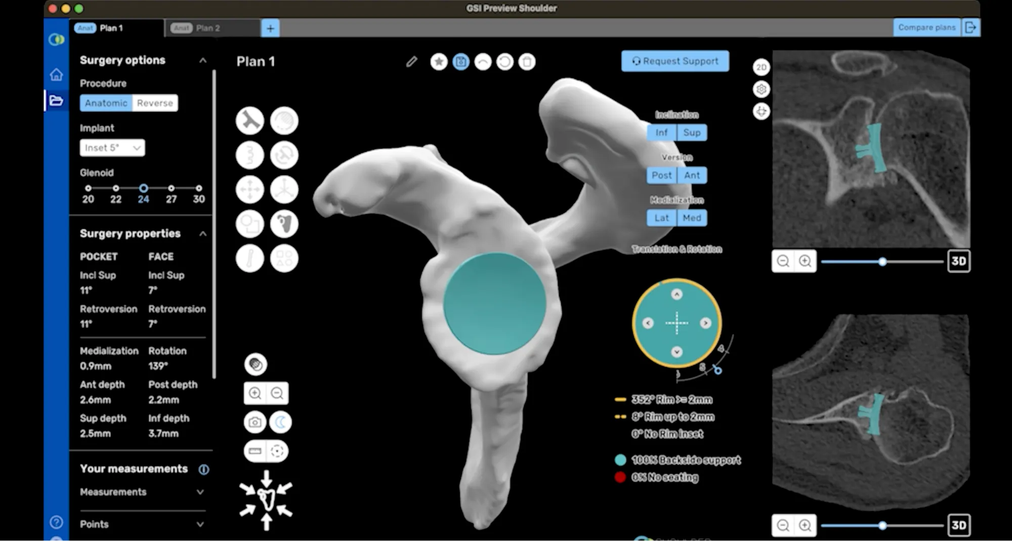 ProVoyance®, a 3D computerized planning software