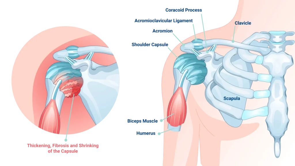 frozen shoulder comparison anatomical labeled image of a frozen shoulder
