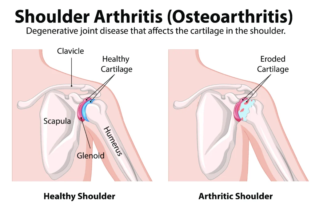 healthy and arthritic shoulder for side by side internal comparison