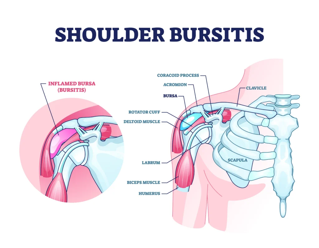 shoulder bursitis internal diagram with labels