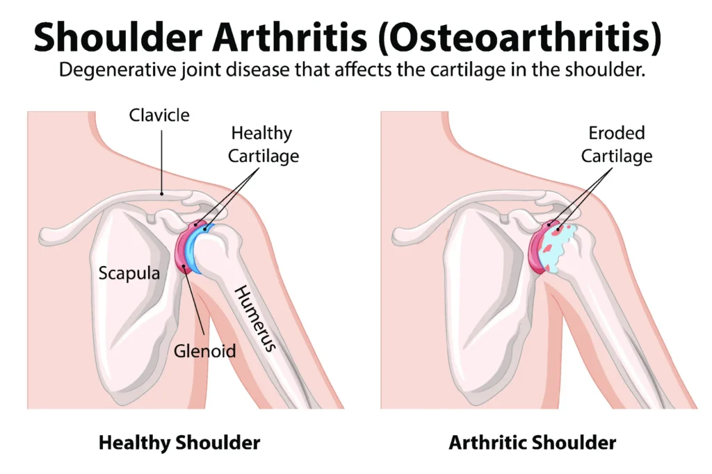 shoulder arthritis comparison Shoulder arthritis anatomical diagram