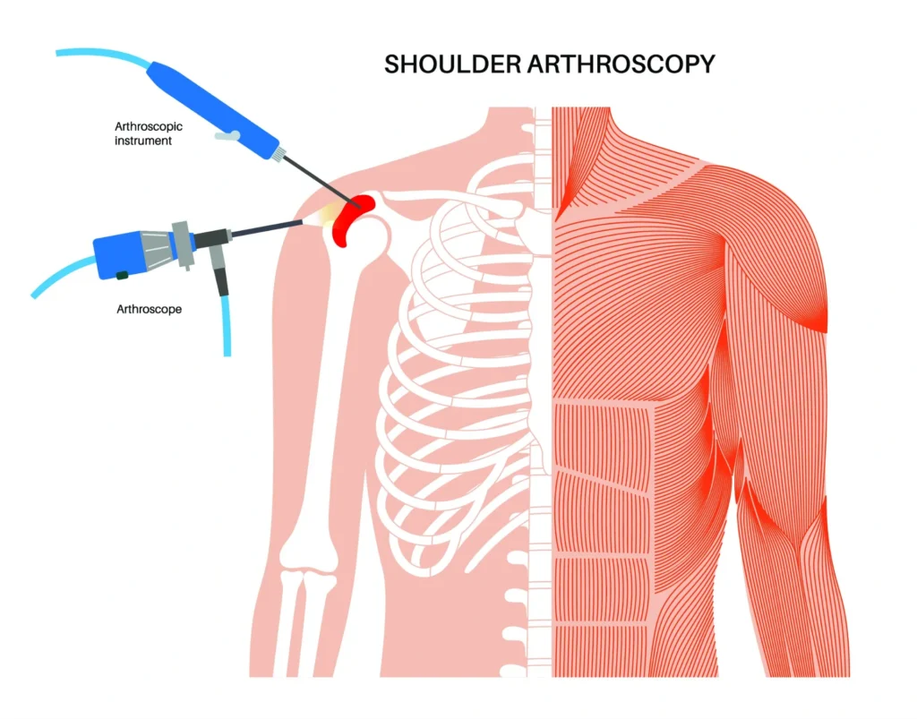 shoulder arthroscopy rotator cuff repair for when an arthroscopic rotator cuff repair is performed