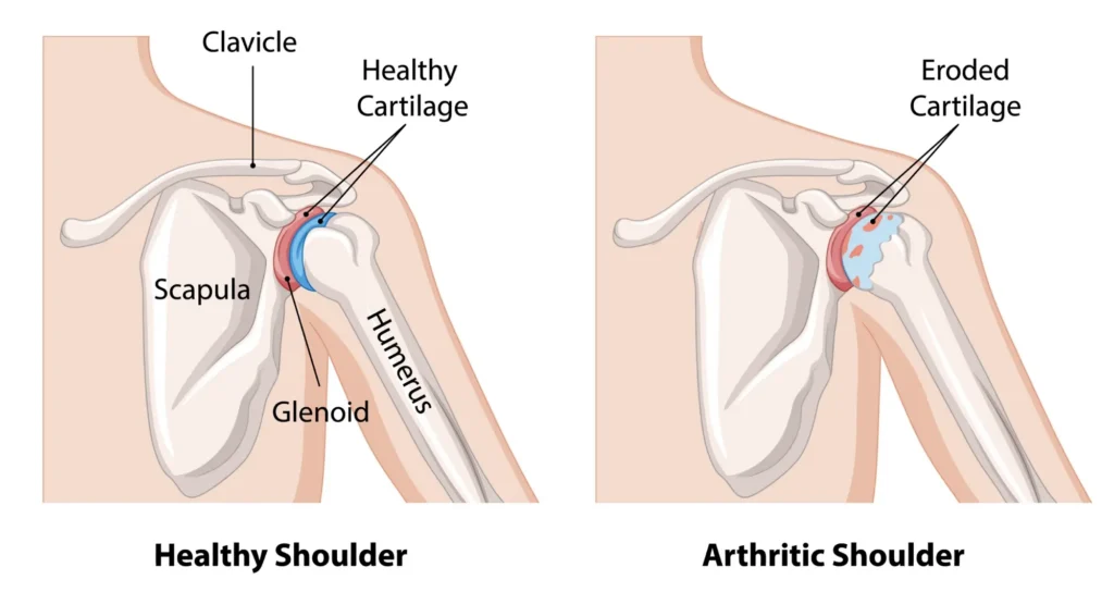 shoulder_arthritis _comparison_v01 shoulder arthritis comparison diagram between a healthy and arthritic shoulder.