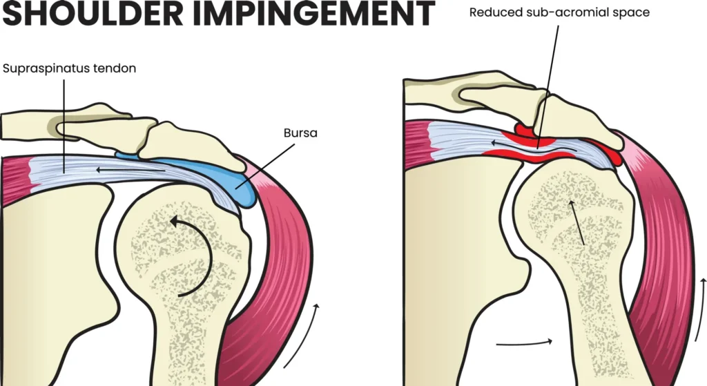 Shoulder impingement diagram, with a focus on the differences between a healthy and injured shoulder. A label to the reduced sub-acromial space can be seen in the injured shoulder.