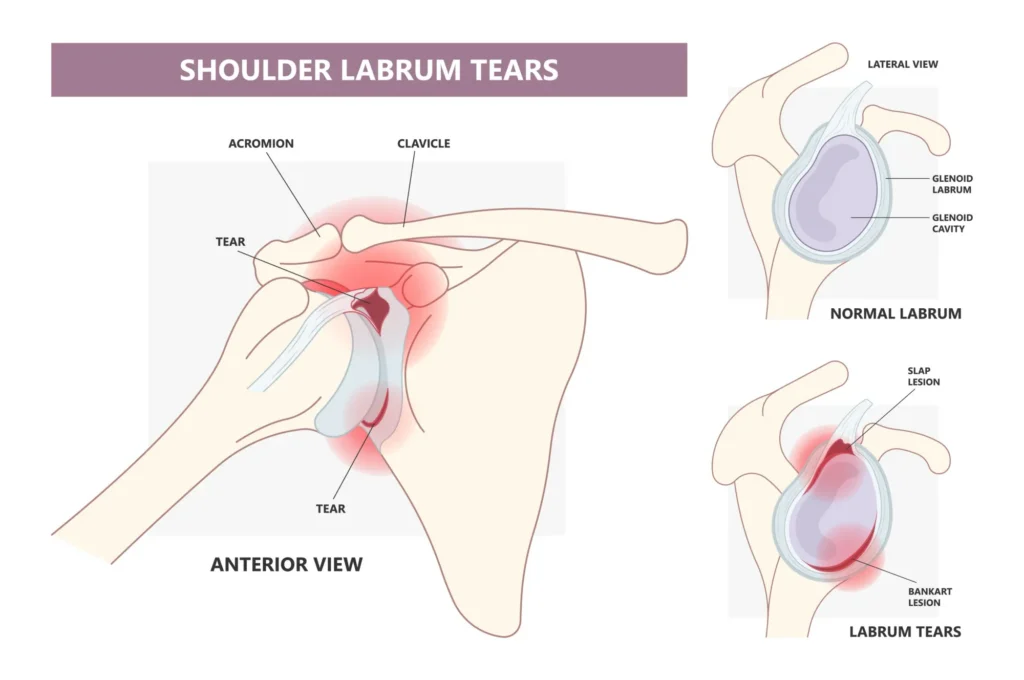 diagram of a bankart tear, focusing on the tear in the anterior-inferior labrum.