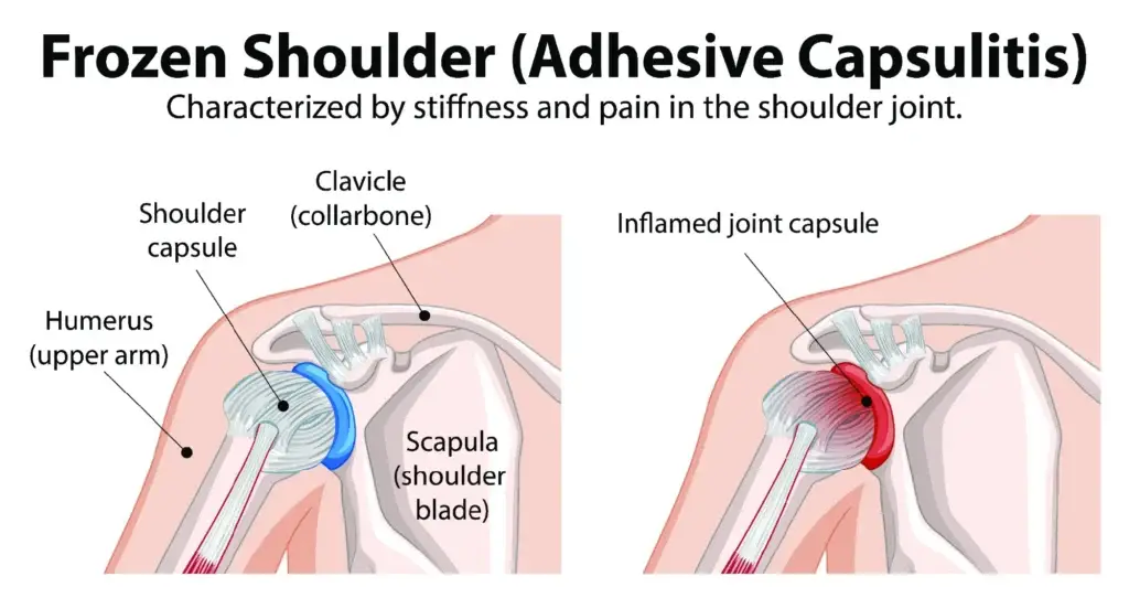 frozen shoulder diagram Comparison diagram between a frozen shoulder and a healthy shoulder