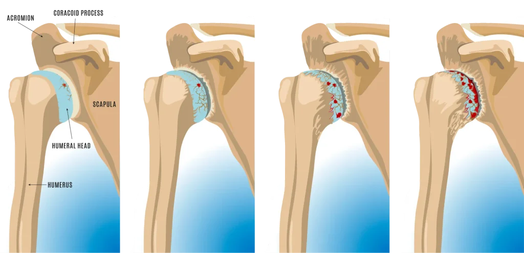 Illustration of four stages of shoulder arthritis, showing cartilage in the humeral head and scapula progressively wearing away to exposed bone.