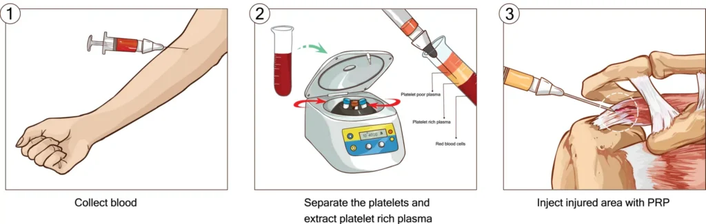 PRP Process Diagram.