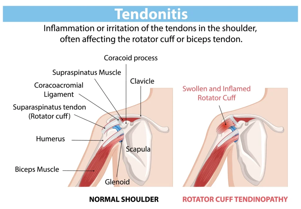 Diagram highlighting shoulder tendinitis.