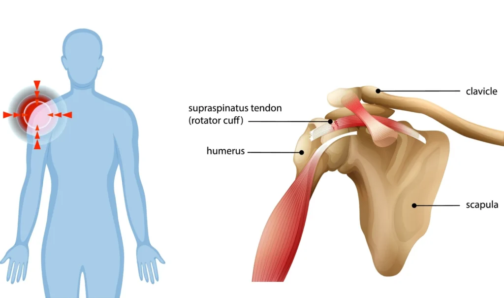 Illustration of a torn rotator cuff, showing the supraspinatus tendon tear at the shoulder joint alongside the humerus, clavicle, and scapula.